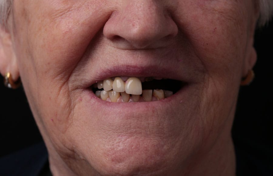 Implantati — Prej 1