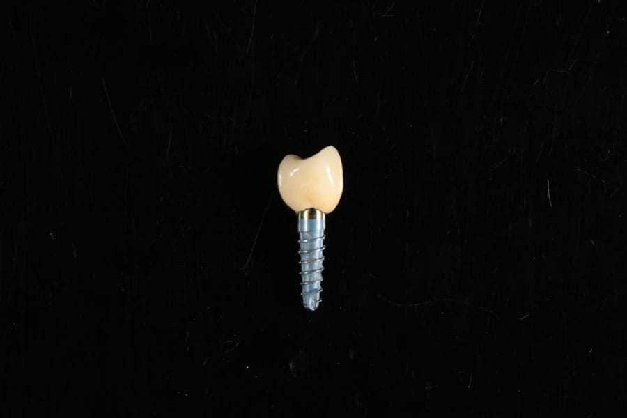Koliko časa traja zobni vsadek? Realna življenjska doba implantatov (2026)